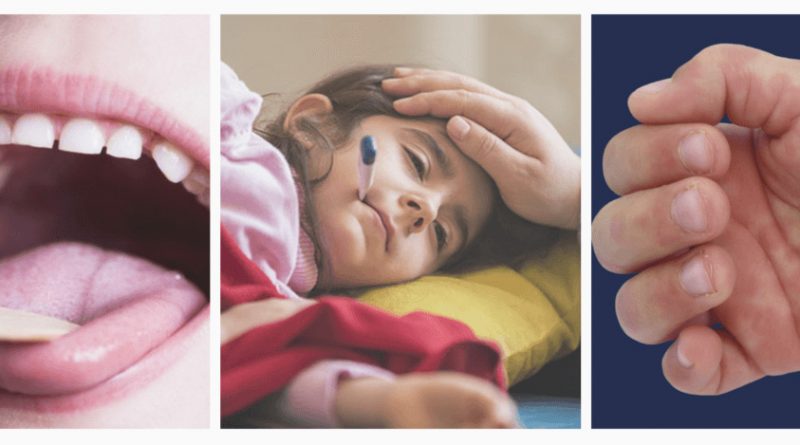 سندرمی نادر