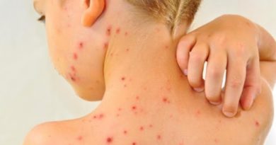 سرخک کودکان