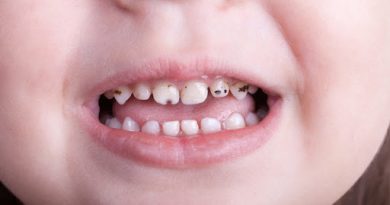 سیاه شدن دندان کودکان-پوسیدگی دندان کودکان