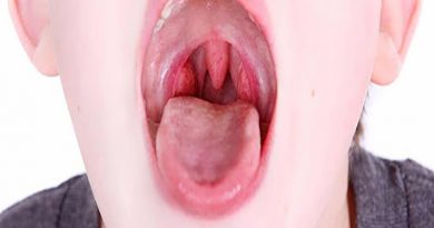 لوزه سوم کودکان