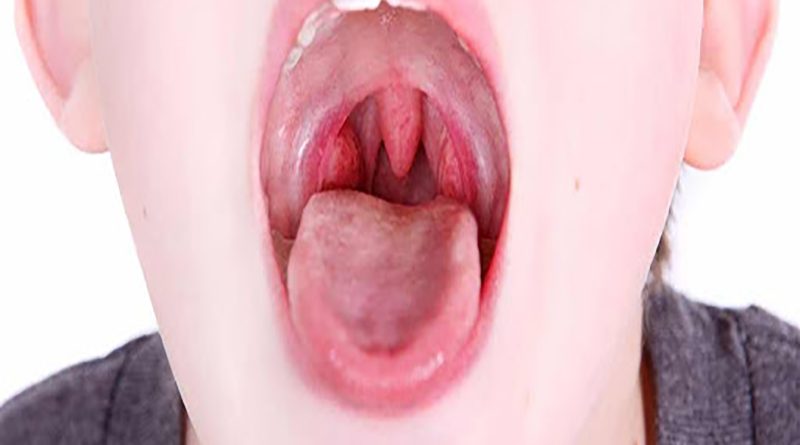 لوزه سوم کودکان