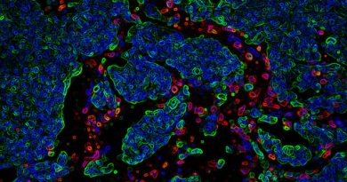 کشف مولکولی که به درمان بهتر سرطان مغز کودکان کمک ‌می‌کند