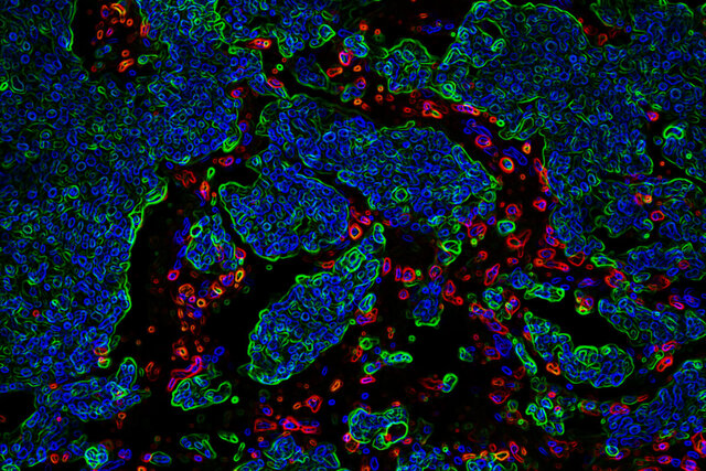 کشف مولکولی که به درمان بهتر سرطان مغز کودکان کمک ‌می‌کند