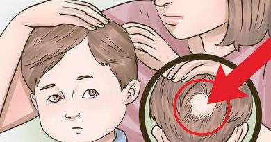 آلوپسی در کودکان