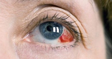 لکه های قرمز