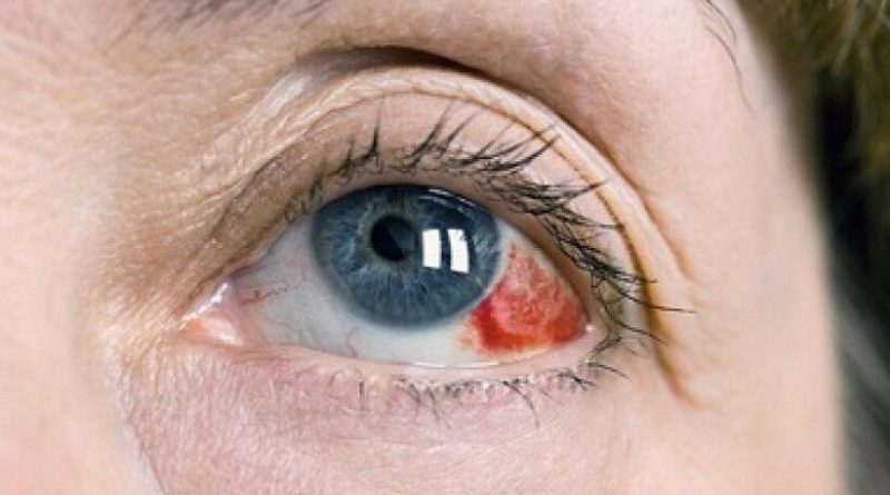 لکه های قرمز