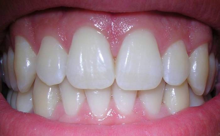 رشد مجدد دندان‌ها