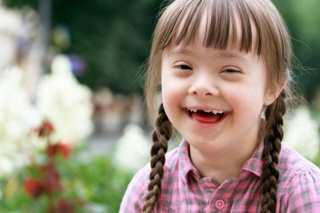 کودک سندروم داون