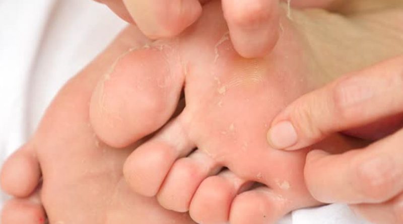 پوسته پوسته