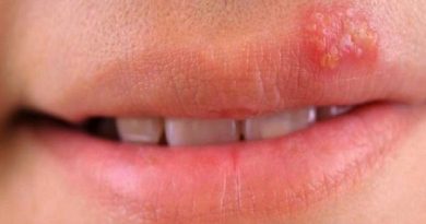 درمان تبخال