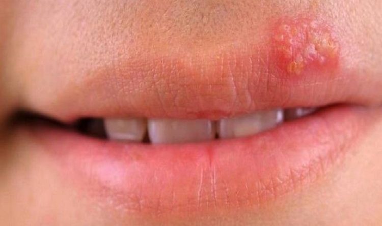 درمان تبخال