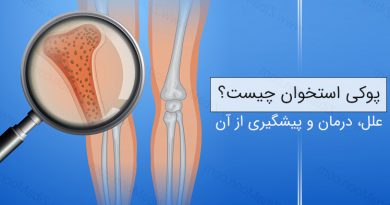 پوکی استخوان