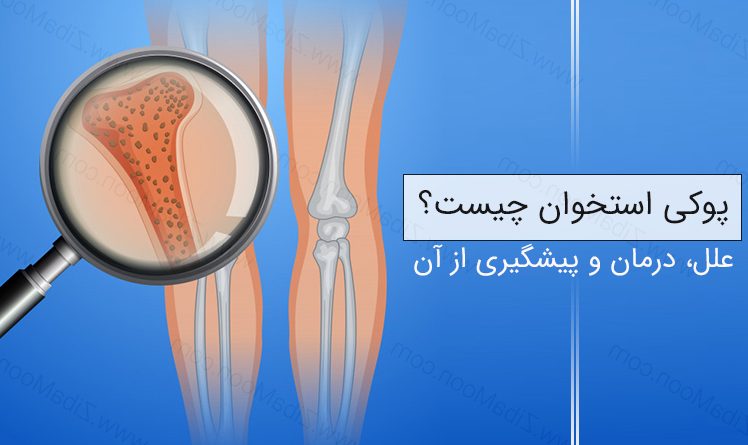 پوکی استخوان