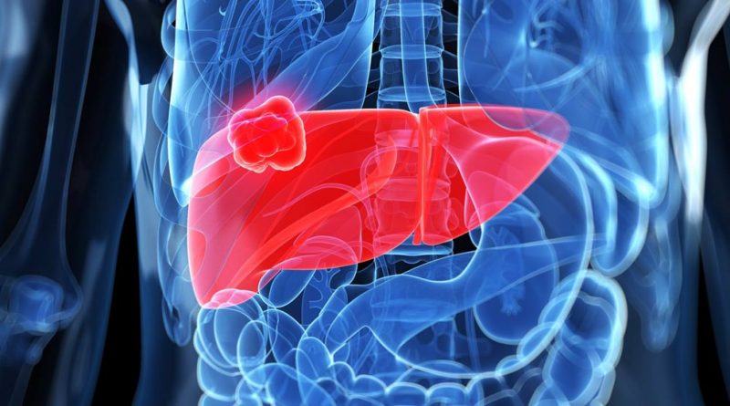 سرطان کبد